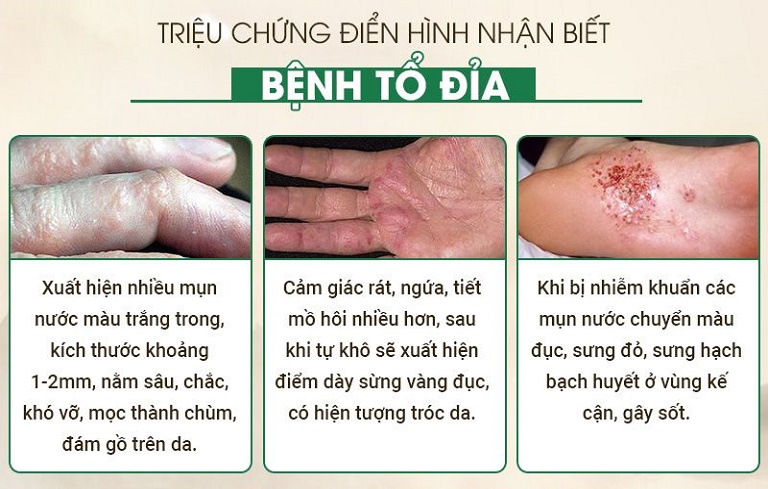 Tin Tức Và Tư Vấn Bệnh Chàm Tổ Đỉa 0444